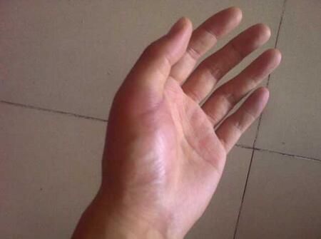 疾病|早上醒来双手发胀,握不拢,几分钟后又恢复正常,这是什么情况?