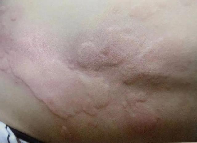 胃炎|警惕！身上的这种小红点是病毒感染，小心越长越多