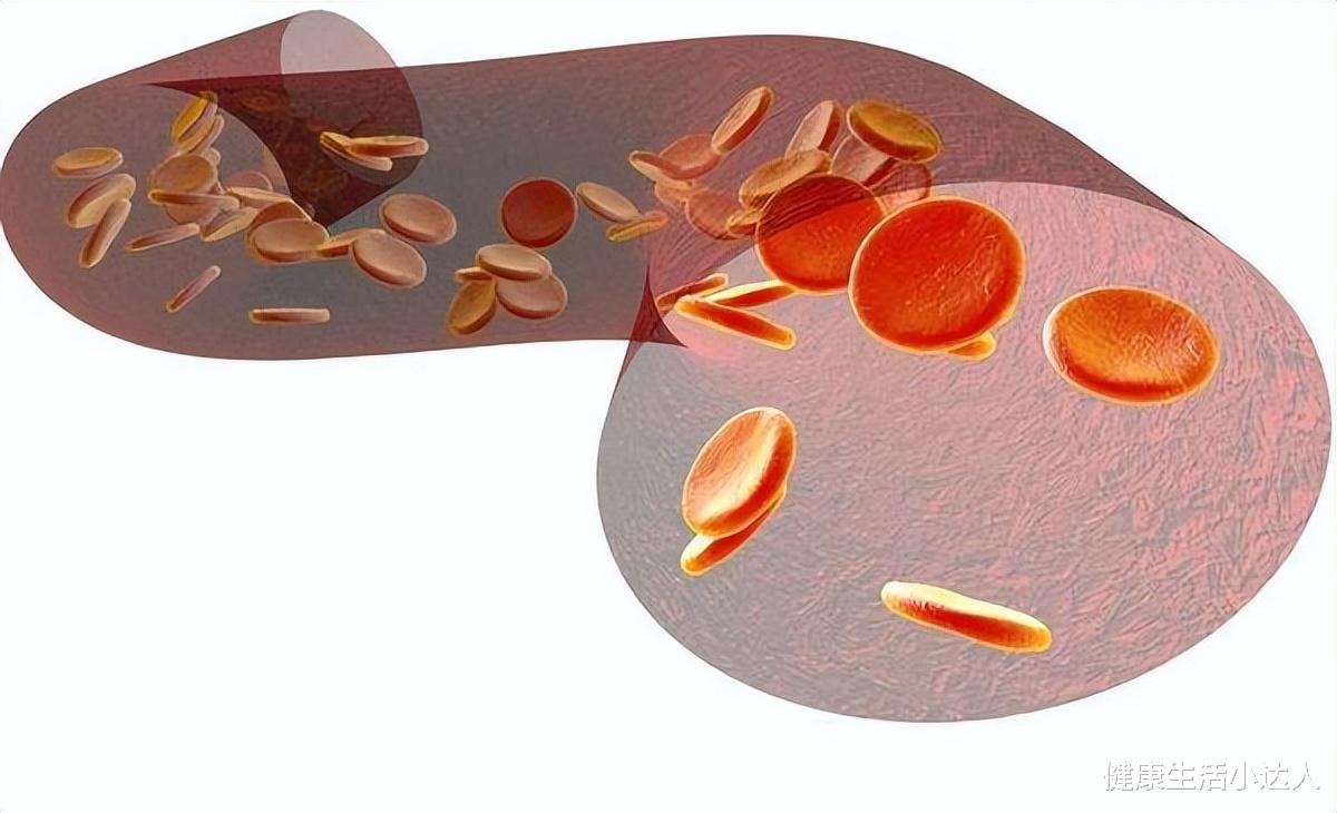 高血脂|血脂一高生百病，5个身体表现提示血脂异常，30秒自测一下