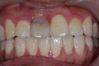 睡眠|牙齿变灰色是怎么回事?