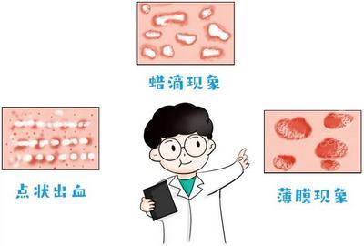 牛皮癣|如何发现牛皮癣复发，牛皮癣复发要怎么预防