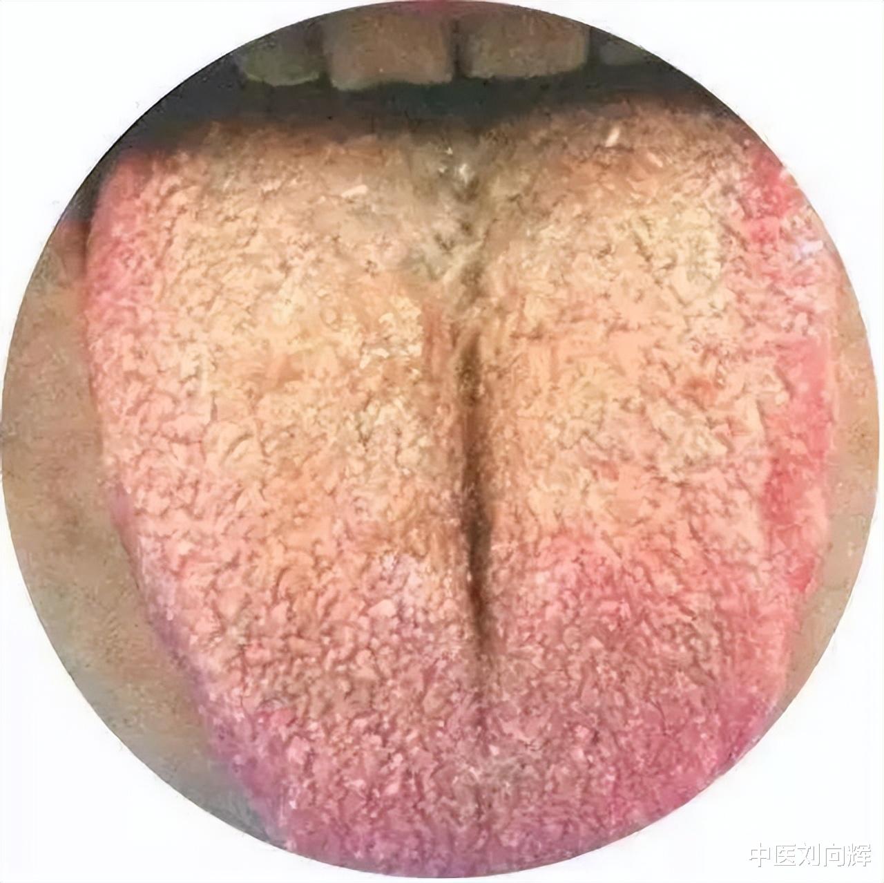 医生|痰和痰湿你分清楚了吗?不同的痰的代表什么呢?教你怎么治疗痰多