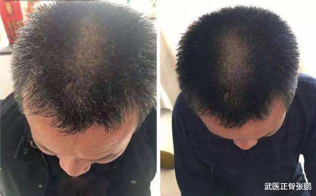 白发|20岁少年长满白发,愁坏家长,老中医给出珍藏1方,轻松长出黑发