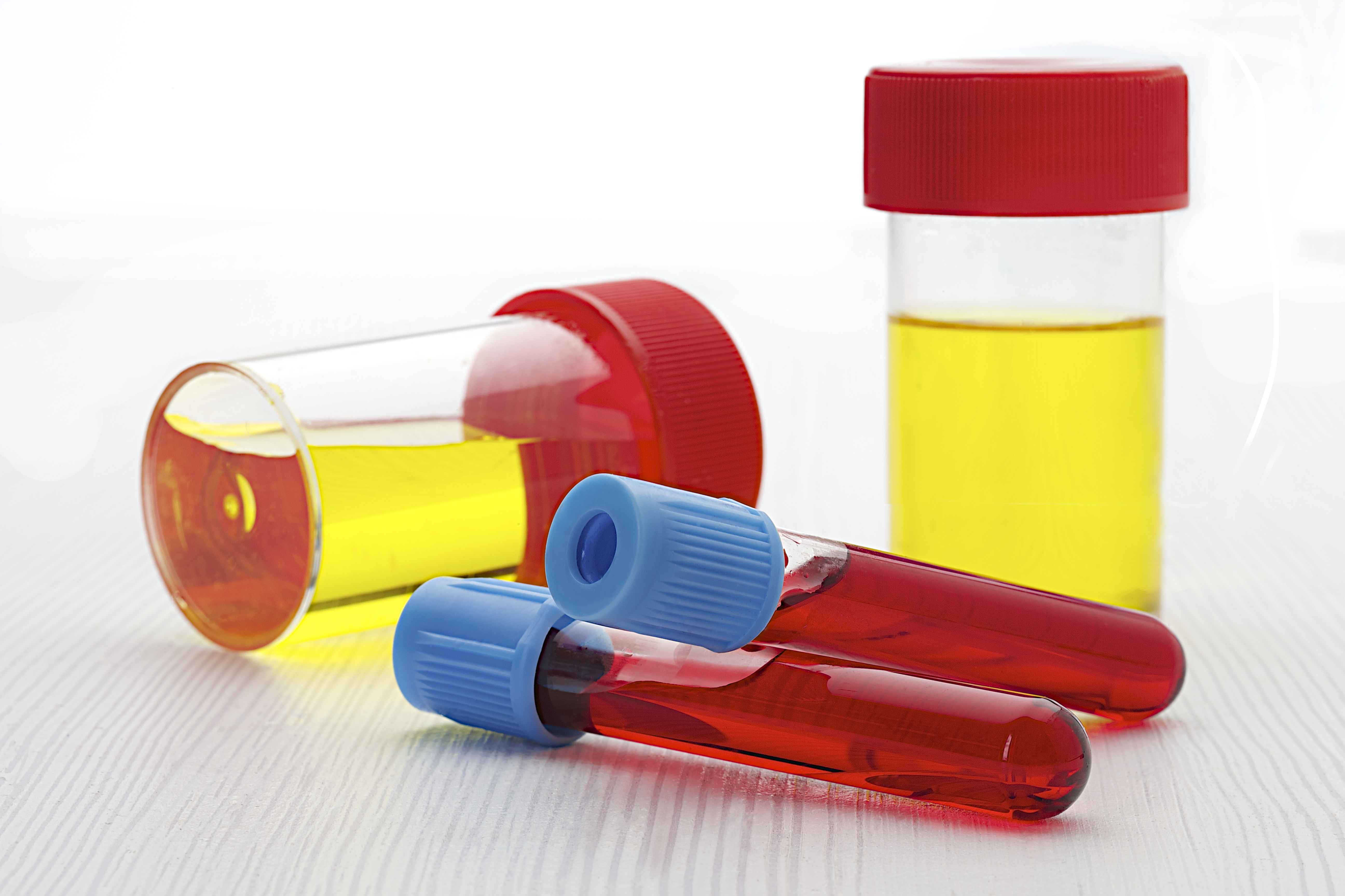 胆固醇|胆固醇偏高如何改善?提醒:除了运动,患者还应做到这几点!