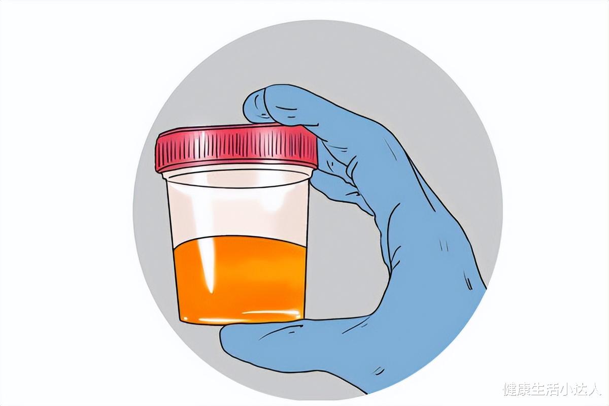 尿酸|尿酸超标了,身体会发出5个信号,抓紧降尿酸,痛风不远了