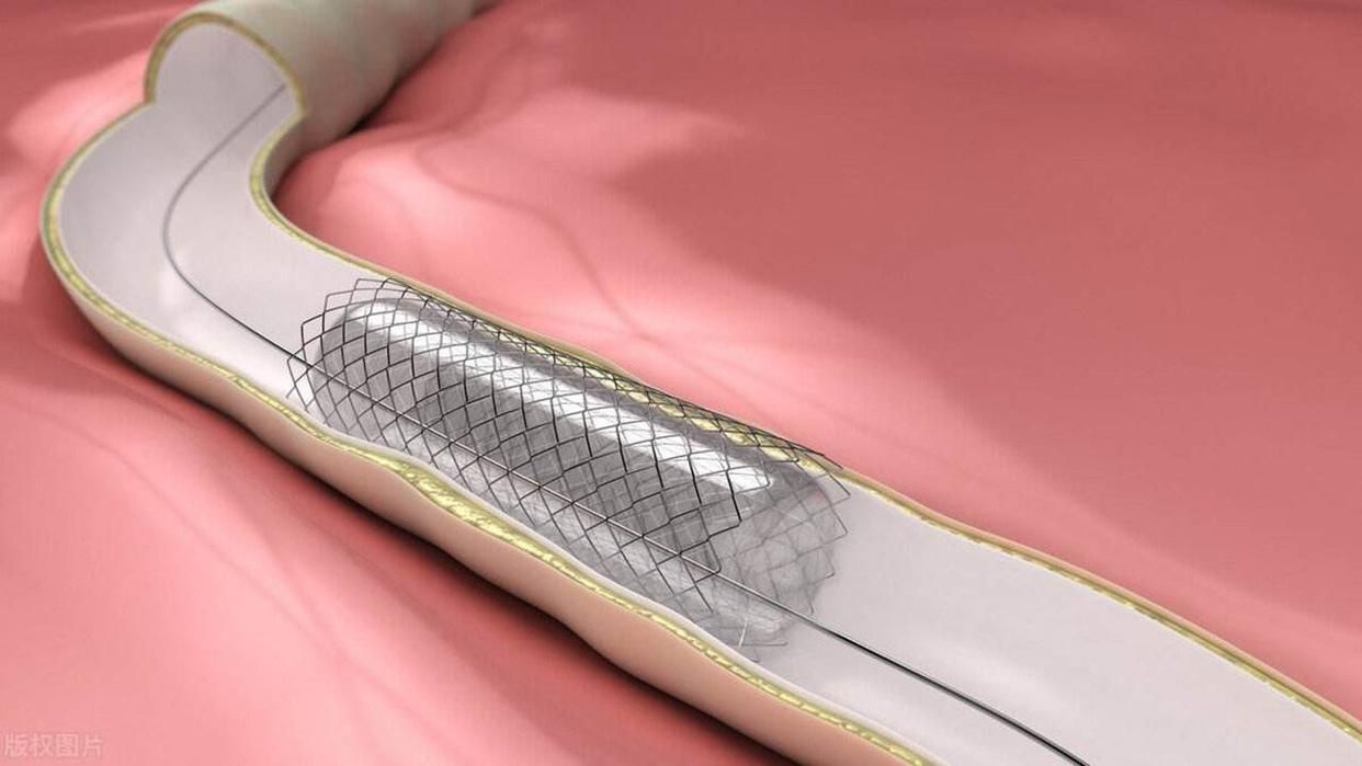 柿子|心梗后放置心脏支架,还能多活几年?这一次医生说了大实话