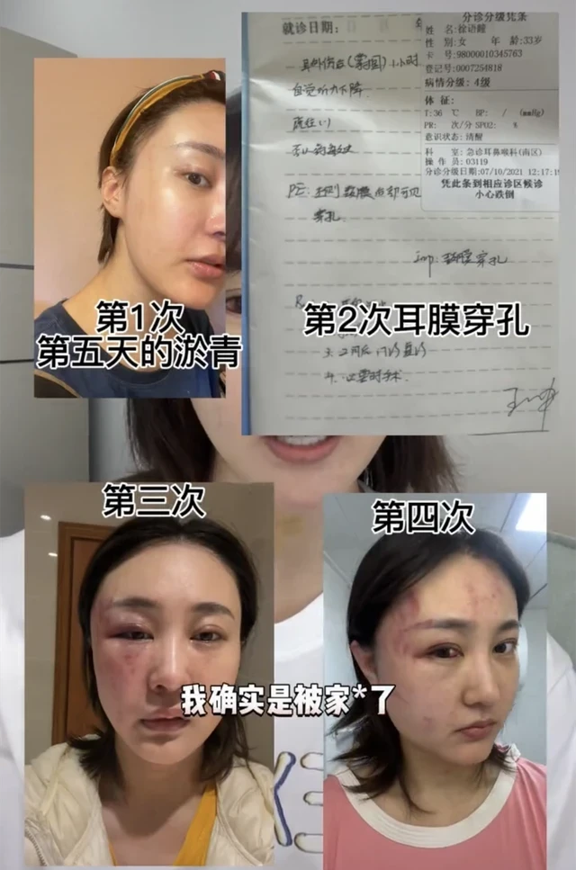 徐大宝|网红徐大宝惨遭家暴后续:女方现身派出所,丈夫已被正式拘留