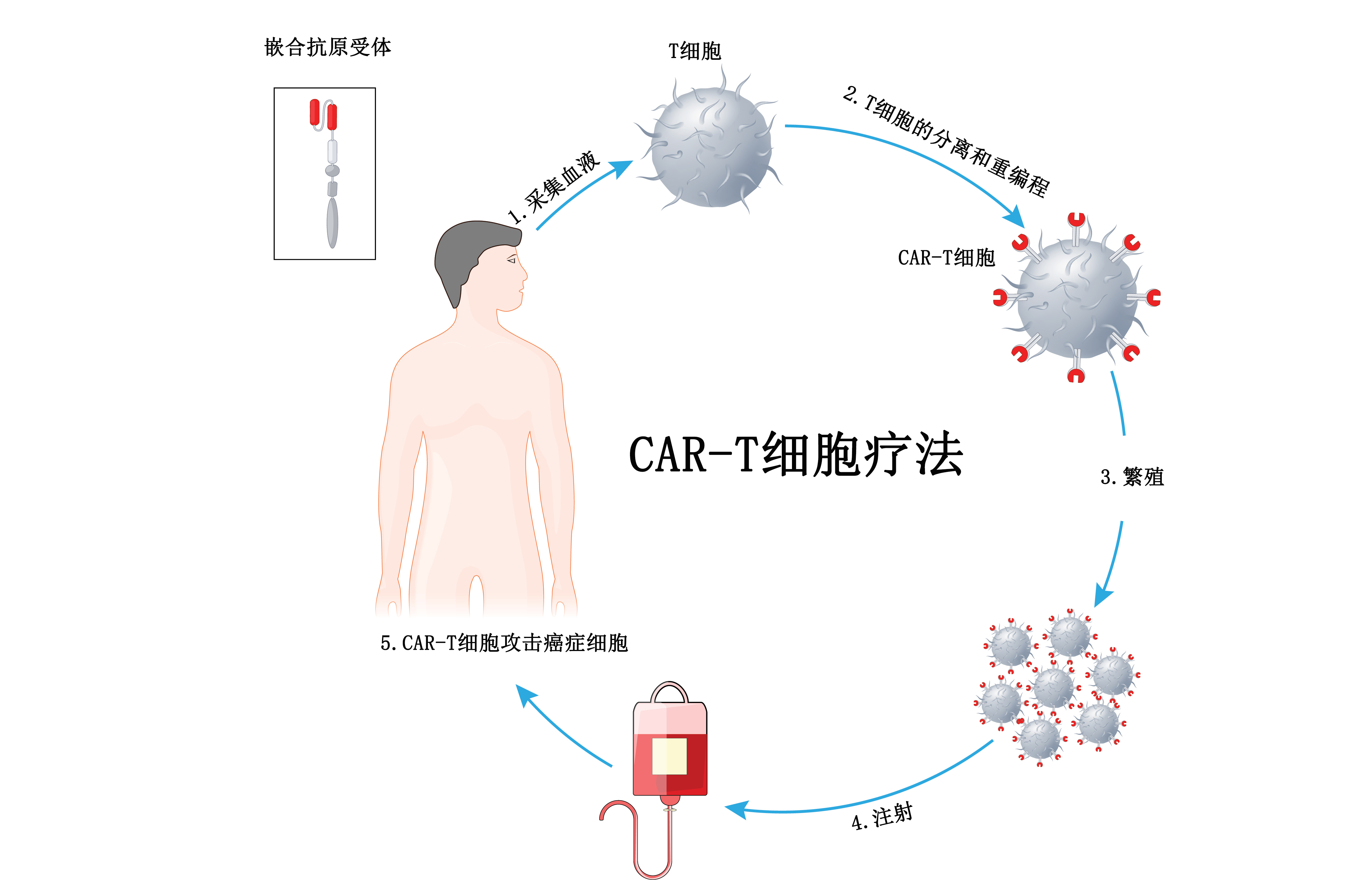 复发/难治性滤泡型淋巴瘤CAR-T细胞疗法Kymriah获FDA加速批准