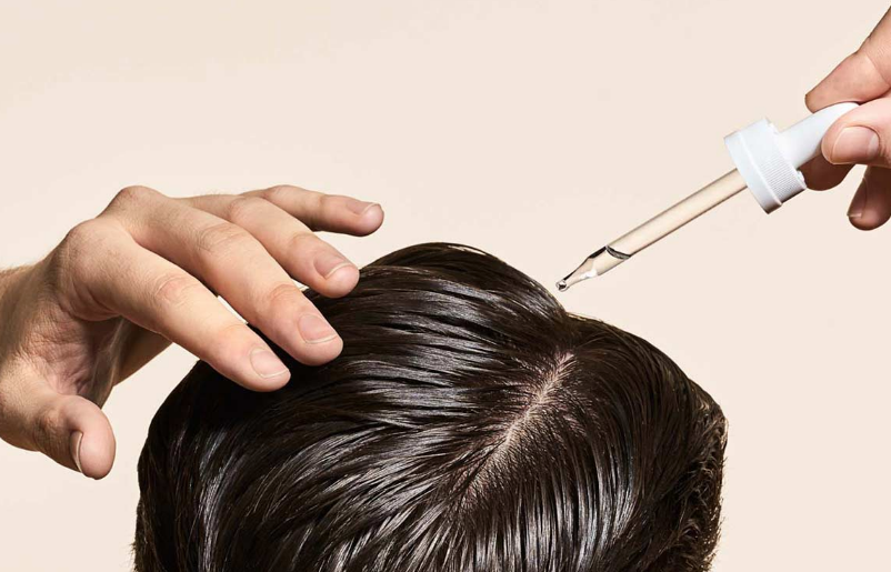 脱发|“米诺地尔”治脱发有副作用？哪些人不能用？不妨收藏以便查看