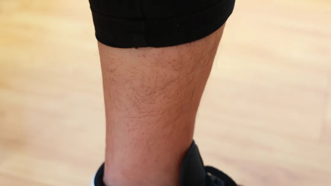 肝功能|腿痛是怎么形成的?关于腿痛的这3种“病根儿”,莫要忽视了