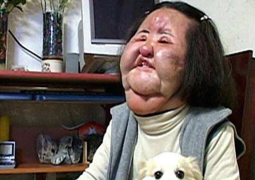 韩慧景|痴迷整容15年,把脸整成“电风扇”后遗症明显,韩慧景后悔了吗?