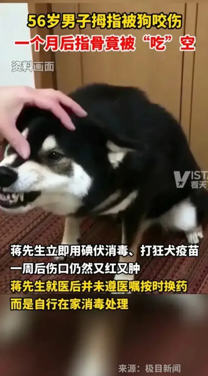 牧风芳华 男子大拇指被狗咬了，一个月后趾骨没了
