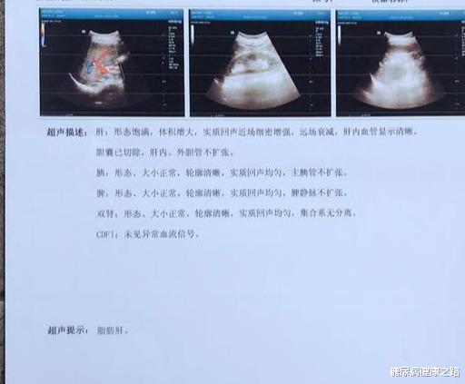 糖尿病|糖尿病常见检查表与数据分析,糖友们自己对一对,看看控制怎么样