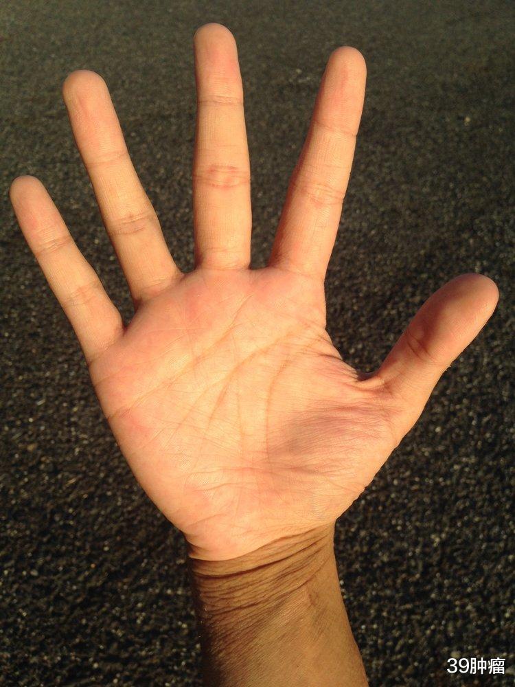 癌细胞|被癌症“看”上的人，手脚可能有哪些异常？出现4大症状要当心