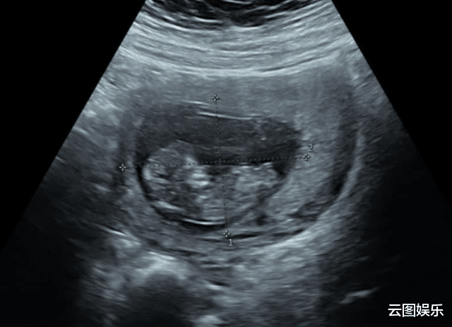 医生|恭喜！38岁女星宣宣打200针终于成功怀孕，肚皮满是淤青令人心疼