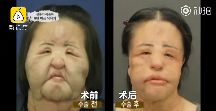 韩慧景|女星韩慧景：为了更漂亮，给脸注射食用油，把脸整成“猪头”