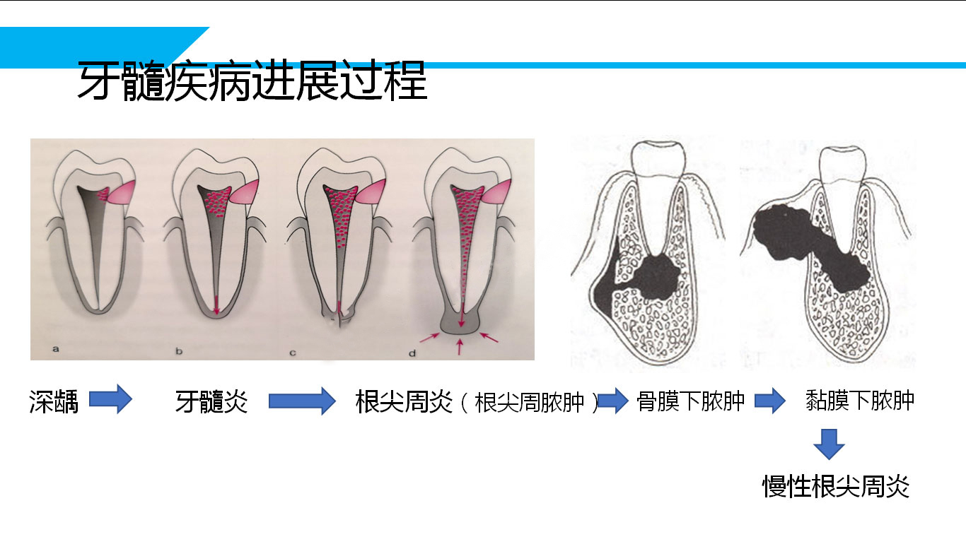 肝脏|为什么根管治疗后要戴牙套？