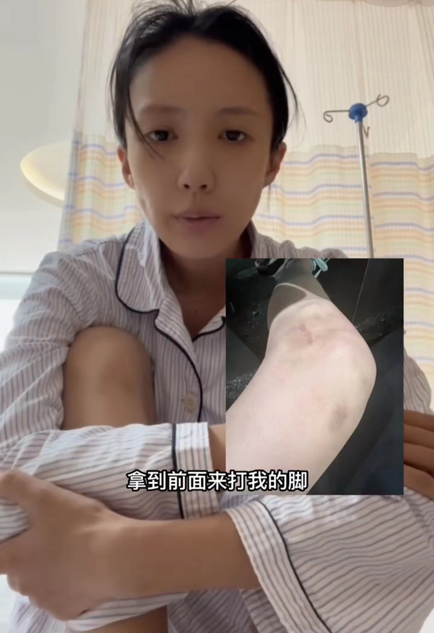 演员王东老婆遭公公殴打,小区撞车拖行六百米,用铁棍狠砸女方脚