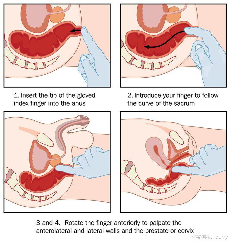 医生|身体发出这4个信号,建议及时做肛门指检,别太害羞了