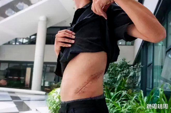 国行|10年了,卖肾买苹果手机的王阳,如今靠透析苟活,谁之过?