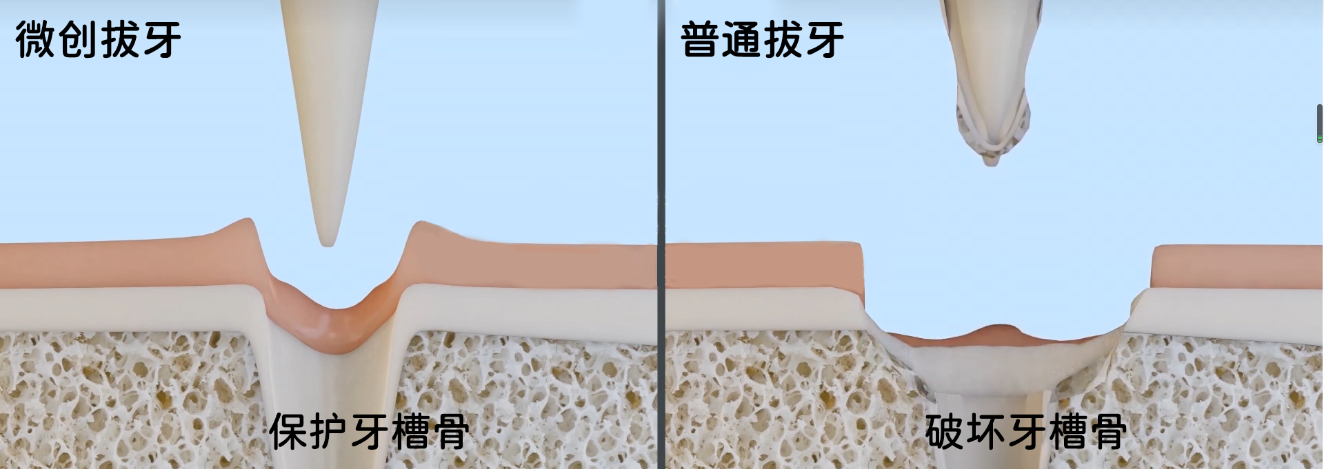 拔牙|什么是微创拔牙?微创拔牙的禁忌症与注意事项有哪些?