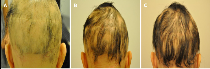 更年期|应用案例 |干细胞促进毛囊再生，有效改善脱发