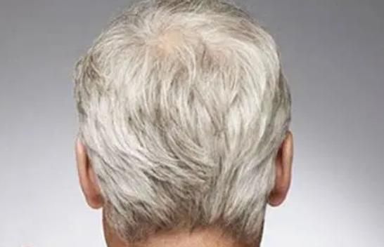 脾胃|白发长在哪,病就从哪出?长在前额、两鬓、后脑勺,分别代表什么