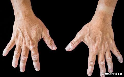 白癜风|患白癜风与自身体质有关系吗?