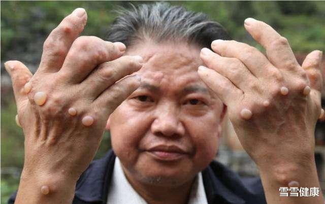 |医生提醒:1种你常喝的水,正在偷偷地升高你的尿酸,很多人天天在喝