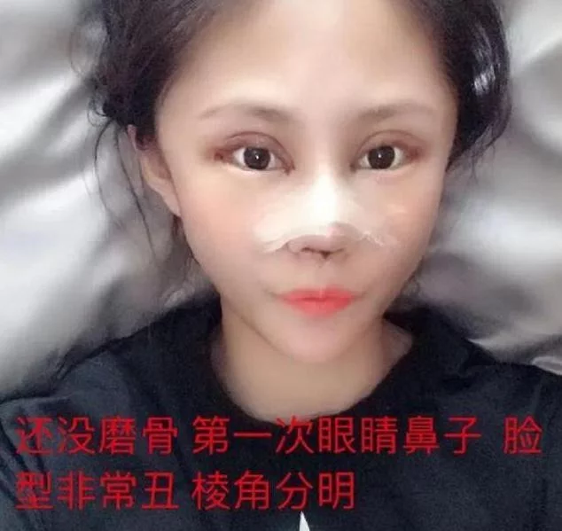岳云鹏|还记得13岁开始整容,花费上百万整容60次的女孩吗?现状令人唏嘘