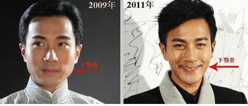 整容|这些整容失败的男星，面如僵石，五官乱飞，后遗症明显