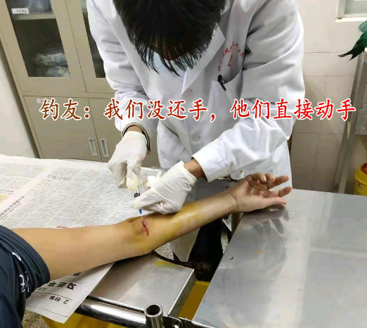 水库|偷钓水库被管理方砍伤, 竟自行去医院缝针, 钓友无奈几十万收入飞了