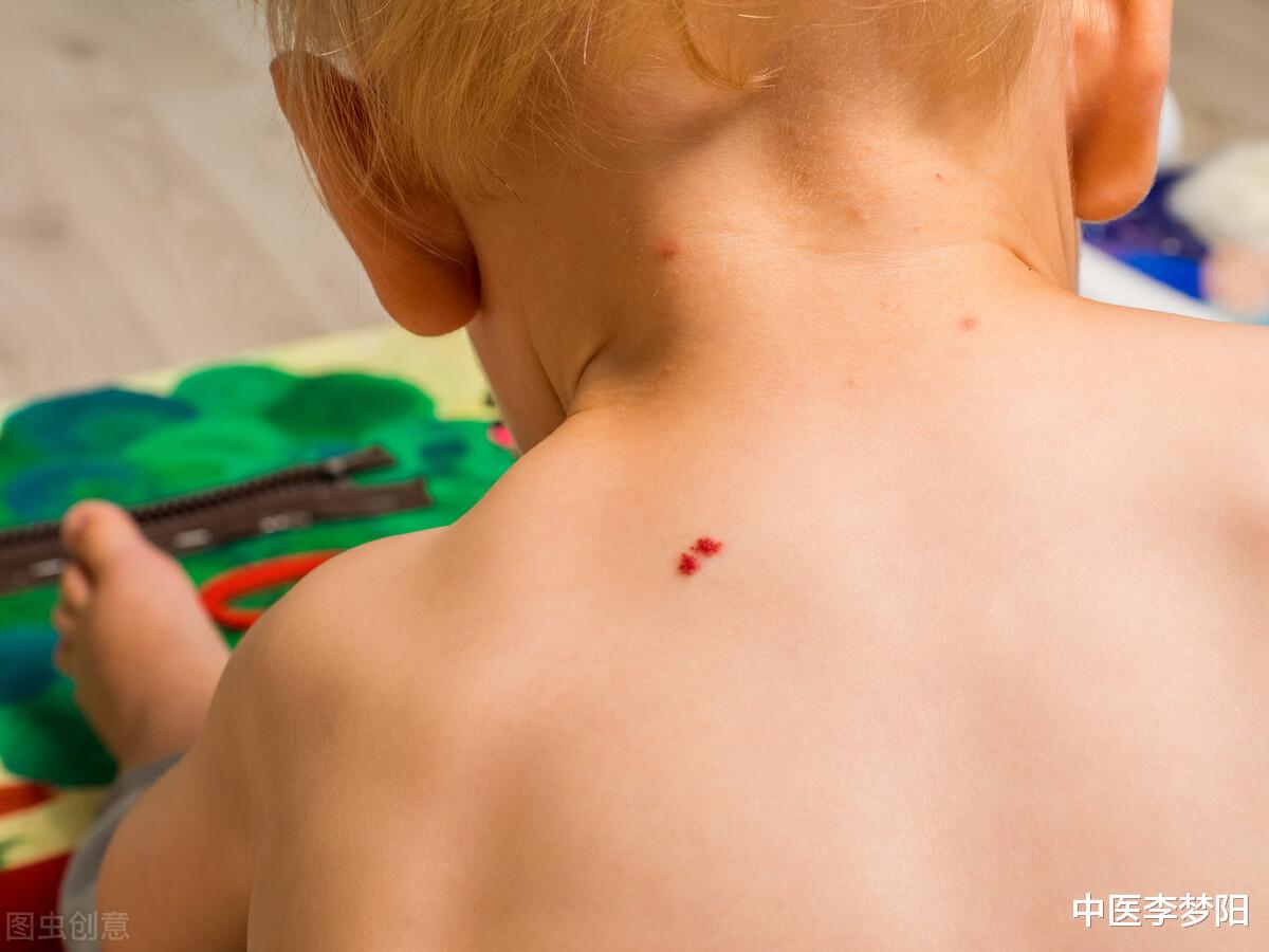 脂肪肝|身上有了血痣,小心是肝胆病变的前兆!李医生教你如何应对
