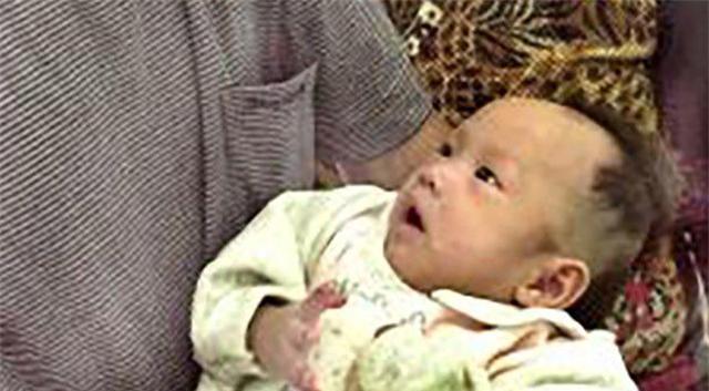 22年前,一对连体女婴成功分身,术后姐姐去世,妹妹如今结婚生子