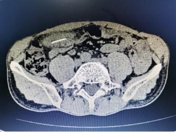 医生|惊险！这根鱼骨在他体内“历险”一个月