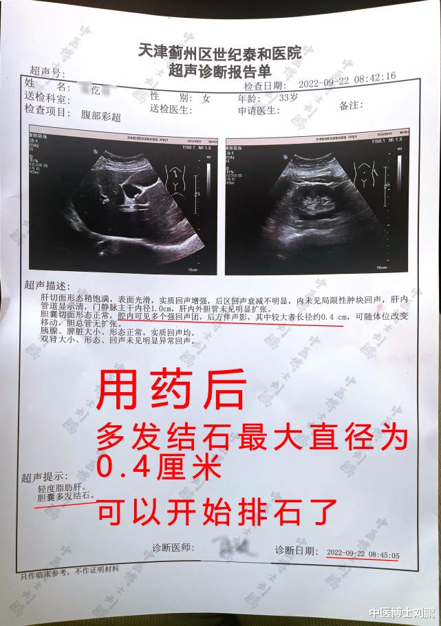 骨质疏松|胆囊炎,胆结石案例