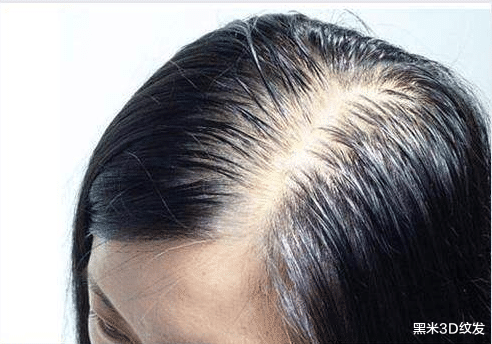脱发|脱发秃顶,可能是这些原因引起的!