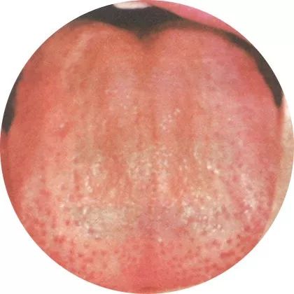 失眠|中医中的舌诊,了解吗