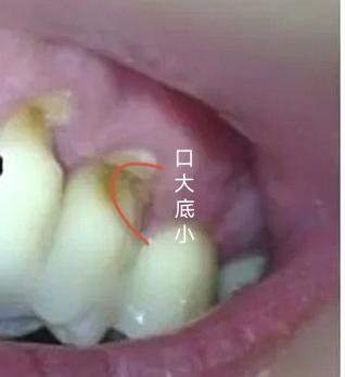 |牙友：口腔科普丨你不会还用拉锯式刷牙吧？