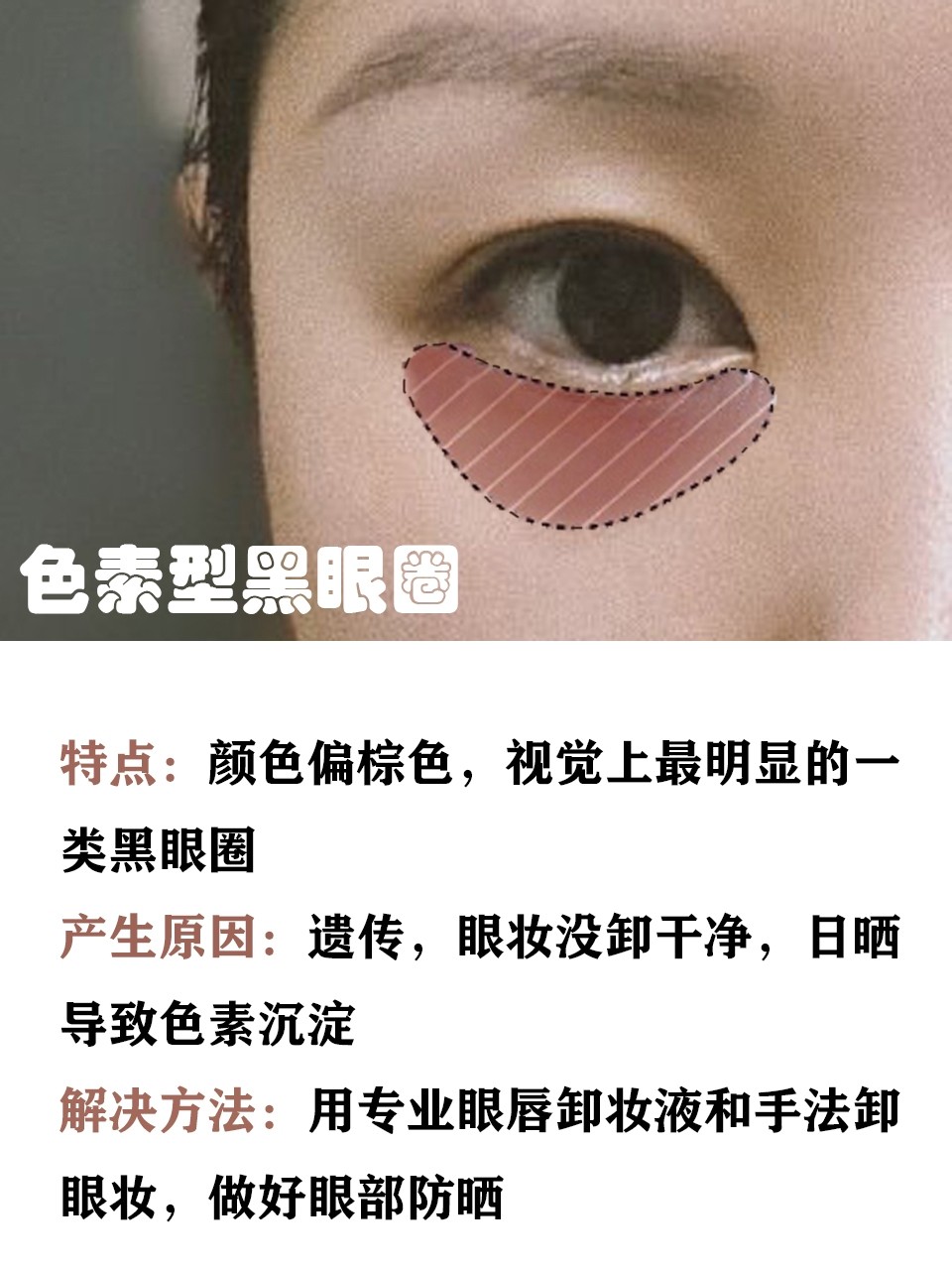 眼妆 你是哪种黑眼圈？黑眼圈类型解析，简单几步淡化你的黑眼圈 。