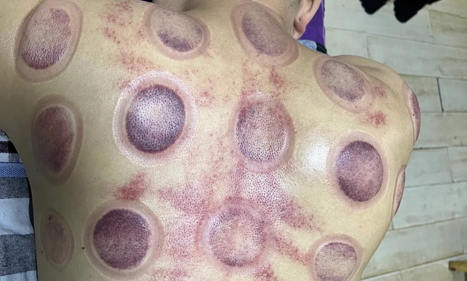 碳水化合物|口腔溃疡、皮炎、高血压、耳道炎等顽疾伴我久矣,防治方法经验分享