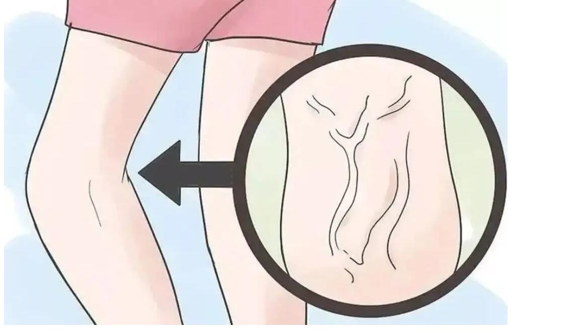 高血压|静脉曲张的10大误区，看看你踩中几个