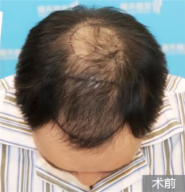 植发|脂溢性脱发怎么治疗？我通过FUE植发技术治好了，共勉