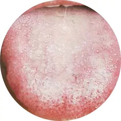 失眠|中医中的舌诊，了解吗