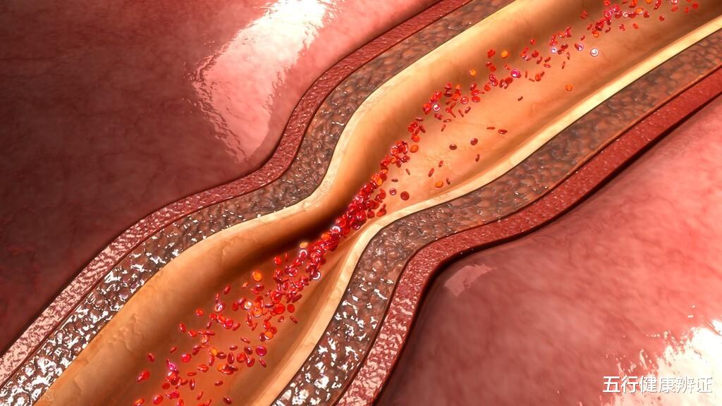 咽炎|三焦不通，可能血脂高！肝、脾、肾、脉四者同调，降血脂，通三焦