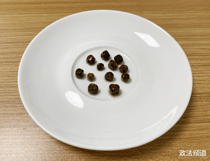 血糖|11岁女童反复“肚痛”就医,原来祸首竟是12颗话梅样胆囊结石