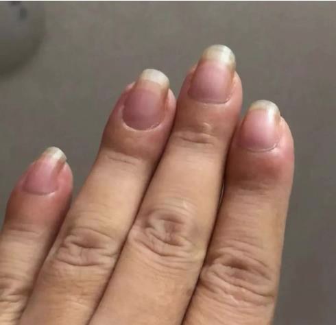 自闭症|指甲若长成6种样子，可能是癌或疾病的信号，要引起重视