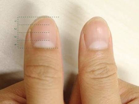 疫苗|半月痕只有大拇指有是怎么回事？