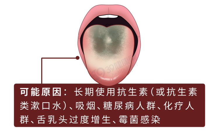 口臭|体内有疾，舌头先知？提醒：舌头出现这些变化，可能是生病了