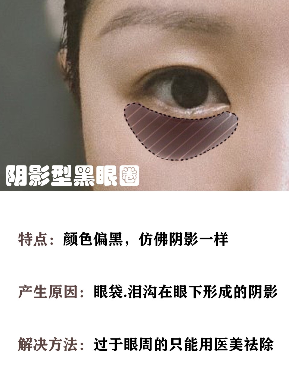 眼妆 你是哪种黑眼圈？黑眼圈类型解析，简单几步淡化你的黑眼圈 。
